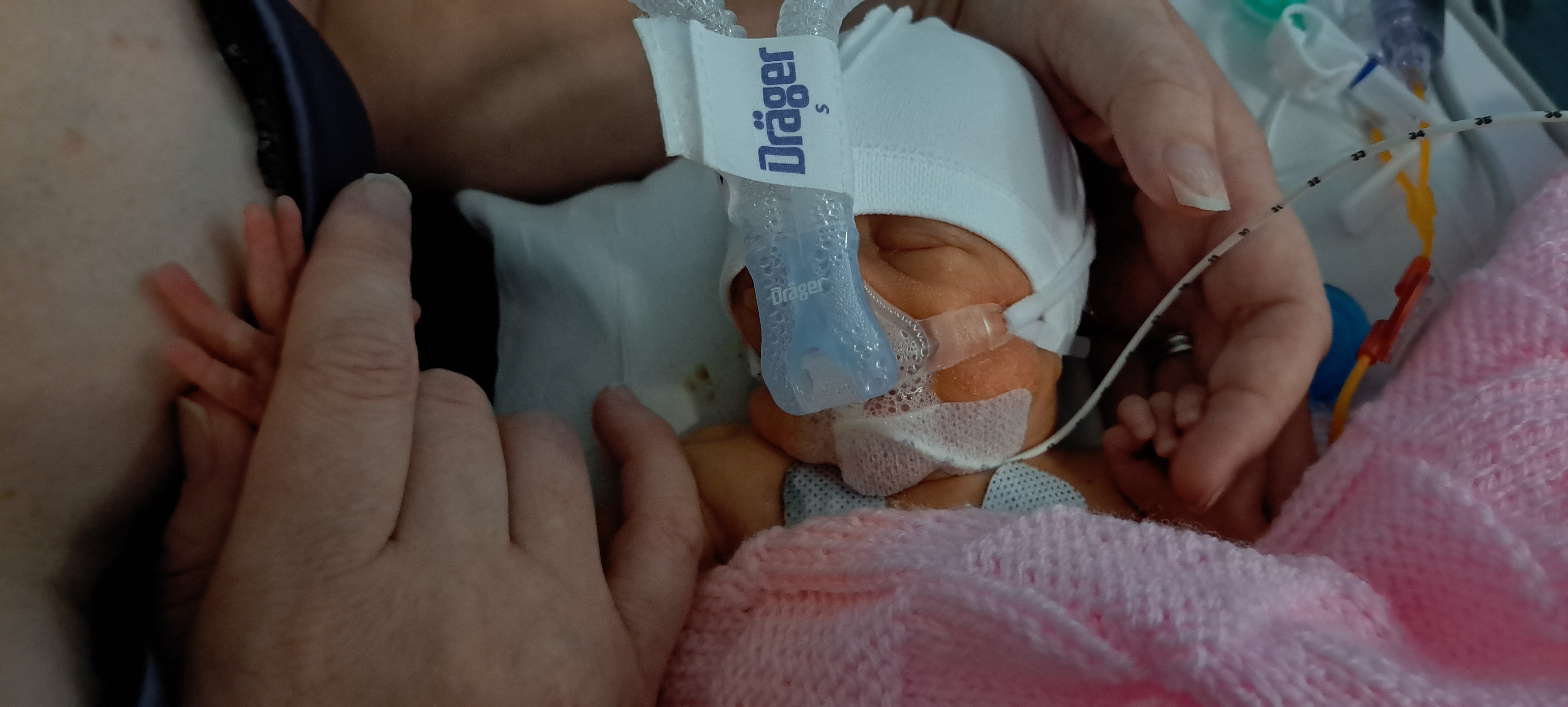 Imogen with breathing support in the NICU